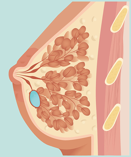 Ilustração anatômica mostrando cistos na mama