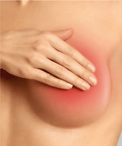 Ilustração de inflamação na mama (mastite)